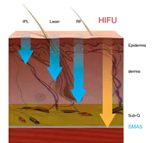 Zen Luxe Med Spa Aesthetic Services with Injector Resha A diagram showing the process of hfu.